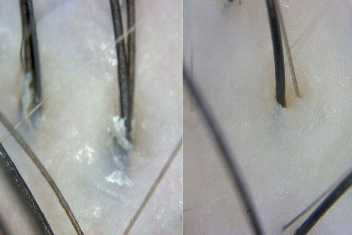 recommend) 18-step stem cell scalp treatment