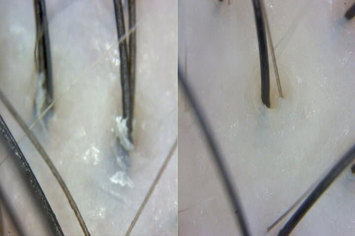 15 Step Stem Cell Scalp Treatment in Seoul